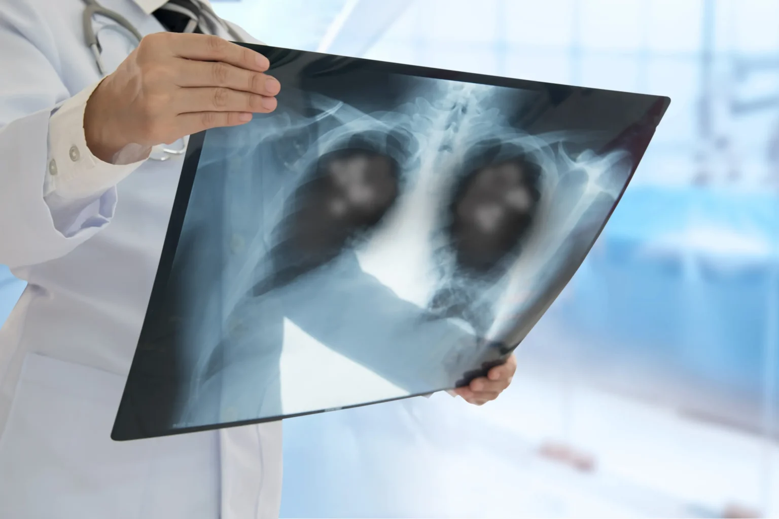 Pneumonia